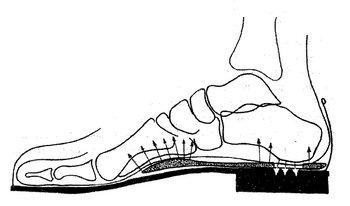 Принцип действия супинированной стельки. Схема расположения стельки и обуви.